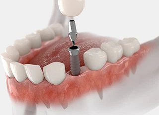 Догляд за коронками