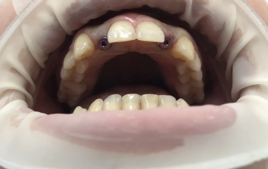 Догляд за дентальними імплантами