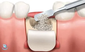 Кісткова пластика
