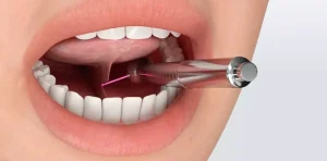 Пластика вуздечки