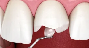 Реставрація зубів