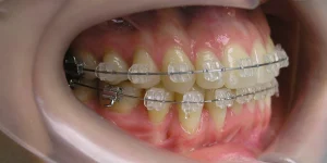 Самолігувальні системи