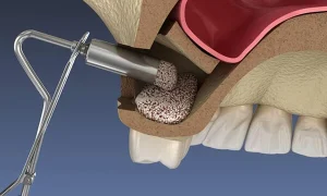 Синус-ліфтинг